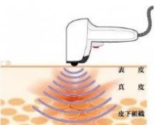 面部提升熱拉提廠家報(bào)價(jià)熱拉提價(jià)格